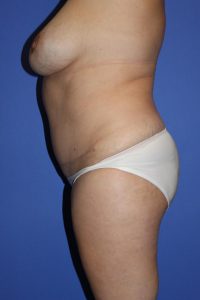 Breast Reduction Mission Viejo
