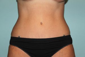 Breast Lift with Implants Mission Viejo