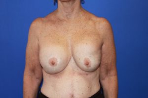 Mission Viejo Breast Reduction