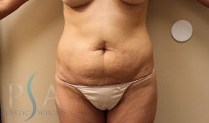 Breast Implants Mission Viejo