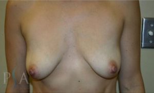 Breast Implants Mission Viejo