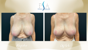 Remove & Replace Implants with Mastopexy